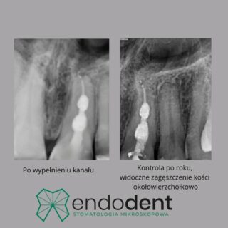 Jako lekarz zajmujący się endodoncją, specjalizuję się w najtrudniejszych przypadkach, w tym między innymi w leczeniu resorpcji wewnętrznej korzenia. To skomplikowane przypadłości, które wymagają nie tylko specjalistycznej wiedzy, ale przede wszystkim precyzyjnego sprzętu – mikroskopu oraz zaawansowanych narzędzi, bez których prawidłowe leczenie byłoby niemożliwe. Dlatego stawiam na najwyższą jakość i nowoczesne technologie, gwarantujące skuteczne i bezpieczne podejście do nawet najbardziej wymagających przypadków.

endodoncja, resorpcjawewnętrzna, mikroskop nowoczesnaleczenie, sieradz

📧 gabinet@endodent.pl 
☎️ +48881666523
