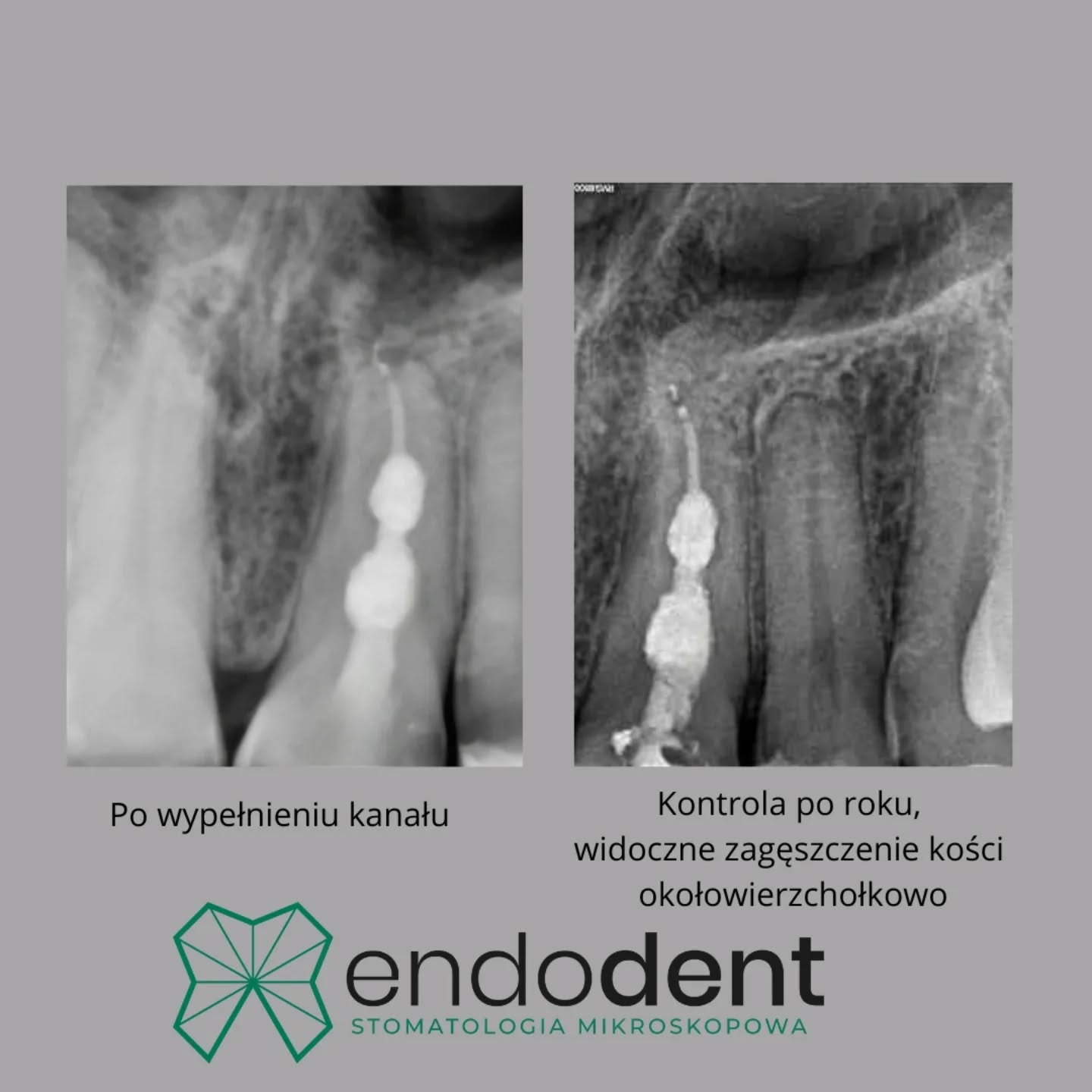 Jako lekarz zajmujący się endodoncją, specjalizuję się w najtrudniejszych przypadkach, w tym między innymi w leczeniu resorpcji wewnętrznej korzenia. To skomplikowane przypadłości, które wymagają nie tylko specjalistycznej wiedzy, ale przede wszystkim precyzyjnego sprzętu – mikroskopu oraz zaawansowanych narzędzi, bez których prawidłowe leczenie byłoby niemożliwe. Dlatego stawiam na najwyższą jakość i nowoczesne technologie, gwarantujące skuteczne i bezpieczne podejście do nawet najbardziej wymagających przypadków.

endodoncja, resorpcjawewnętrzna, mikroskop nowoczesnaleczenie, sieradz

📧 gabinet@endodent.pl 
☎️ +48881666523