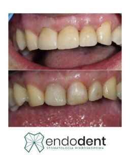 Nowy uśmiech. Dzięki odbudowie zębów koronami cyrkonowymi uzyskaliśmy efekt estetyczny, zadowalający i trwały – idealne rozwiązanie dla tych, którzy chcą odzyskać naturalny wygląd. Przed leczeniem zęby pacjentki były pokryte nieestetycznymi wypełnieniami kompozytowymi, które psuły całościowy efekt. Dzięki nowym, precyzyjnie wykonanym przez @pracowniaprotetyczaiwonaczyzak koronom, uśmiech odzyskał swój blask, a komfort życia znacznie wzrósł. 
Pamiętaj, że piękny uśmiech zaczyna się od profesjonalnego podejścia i dbałości o każdy detal.

📧 gabinet@endodent.pl 
☎️ +48881666523

Stomatologia KoronyCyrkonowe Estetyka Uśmiech MetamorfozaZębów PięknyUśmiech NowoczesnaStomatologia Sieradz Protetyka