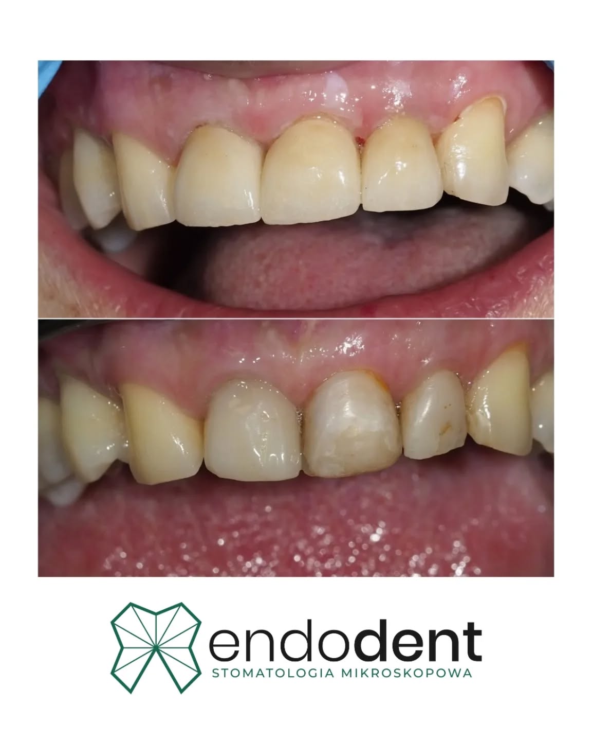 Nowy uśmiech. Dzięki odbudowie zębów koronami cyrkonowymi uzyskaliśmy efekt estetyczny, zadowalający i trwały – idealne rozwiązanie dla tych, którzy chcą odzyskać naturalny wygląd. Przed leczeniem zęby pacjentki były pokryte nieestetycznymi wypełnieniami kompozytowymi, które psuły całościowy efekt. Dzięki nowym, precyzyjnie wykonanym przez @pracowniaprotetyczaiwonaczyzak koronom, uśmiech odzyskał swój blask, a komfort życia znacznie wzrósł. 
Pamiętaj, że piękny uśmiech zaczyna się od profesjonalnego podejścia i dbałości o każdy detal.

📧 gabinet@endodent.pl 
☎️ +48881666523

Stomatologia KoronyCyrkonowe Estetyka Uśmiech MetamorfozaZębów PięknyUśmiech NowoczesnaStomatologia Sieradz Protetyka