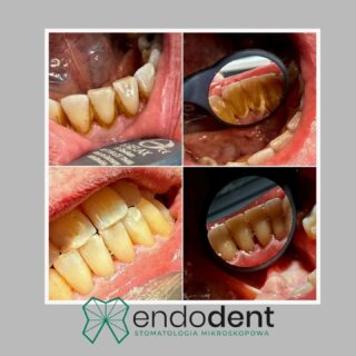 Czysty uśmiech to zdrowy uśmiech!

Czy wiesz, że kamień nazębny powstaje nawet tam, gdzie go nie widać – w tzw. kieszonkach dziąsłowych? 😬 To trochę jakbyś co tydzień wrzucał do kieszeni swojego swetra małe kamyczki… Na początku ich prawie nie czujesz, ale z czasem kieszeń się rozciąga, ciężar rośnie, a materiał – czyli Twoje dziąsła – osłabia się i zaczyna rozciągać.

Dlaczego warto regularnie odwiedzać higienistkę?

1. Scaling (skaling) – profesjonalne usunięcie twardego kamienia nazębnego z powierzchni zębów i spod dziąseł.

2. Piaskowanie – delikatne „oczyszczenie strumieniem” piasku stomatologicznego, które usuwa osady i przebarwienia.

3. Profilaktyka – regularne zabiegi zapobiegają powstawaniu zapalenia dziąseł, próchnicy korzeni i niechcianych wizyt u stomatologa!

🔄 Powtarzaj co 6–12 miesięcy (lub częściej, jeśli zaleci to specjalista), żeby Twoje dziąsła były mocne, a uśmiech lśnił bez przebarwień.

📅 Zarezerwuj wizytę już dziś i daj swoim zębom to, czego potrzebują!
☎️ 881666523 
📧 gabinet@endodent.pl 

#higiena #skaling #piaskowanie #zdrowezęby #profilaktyka #uśmiech #dentysta #higienistka #stomatologia #zdrowiejamyustnej #sieradz @endodent