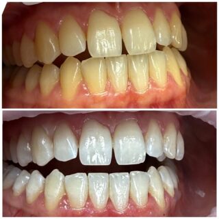 Laserowe wybielanie zębów – nowoczesna i bezpieczna droga do śnieżnobiałego uśmiechu! 👄

Marzysz o białym uśmiechu, ale boisz się bólu i nadwrażliwości po zabiegu? Mamy idealne rozwiązanie – laserowe wybielanie zębów! 🦷

 Dlaczego laser jest lepszy od tradycyjnej lampy?
➡️ Działa precyzyjnie i równomiernie
➡️ Skraca czas zabiegu
➡️ Mniejsze ryzyko podrażnień i nadwrażliwości
➡️ Efekty są widoczne szybciej i utrzymują się dłużej

📆 Zabieg składa się z dwóch wizyt – to gwarancja pełnego bezpieczeństwa i kontrolowanego efektu wybielenia.

🪥 Po wybielaniu kluczowa jest idealna higiena jamy ustnej – regularne szczotkowanie, nitkowanie i unikanie barwiących produktów pomogą utrzymać śnieżnobiały efekt na długo!

😬 A co jeśli masz zęby trudne do wybielenia?
Wtedy warto wspomóc się specjalnymi nakładkami do stosowania w domu, które podtrzymają efekt i pozwolą osiągnąć wymarzony kolor.

💬 Napisz do nas lub umów się na konsultację – doradzimy najlepszą metodę wybielania właśnie dla Ciebie!

📧 gabinet@endodent.pl 
📞 881666523

#WybielanieZębów #LaseroweWybielanie #PięknyUśmiech #ZdroweZęby #wybielanie #stomatologia #StomatologiaEstetyczna #BiałyUśmiech