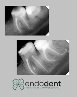 Wielu dentystów, widząc trzeci ząb trzonowy, od razu sugeruje usunięcie. Argumentują, że „ósemki psują zgryz” – a to często nieprawda. Problem tkwi w czymś innym: ósemki mają wyjątkowo skomplikowaną anatomię. Ich korzenie bywają zagięte, zakrzywione czy nieregularne, przez co wielu lekarzy nie chce podejmować ryzyka leczenia kanałowego.

A przecież te zęby potrafią odegrać ogromną rolę w planie leczenia protetycznego – zwłaszcza, gdy brakuje szóstek, czyli pierwszych zębów trzonowych.

👉 W naszym gabinecie nie poddajemy się tak łatwo. Zajmujemy się nawet najbardziej wymagającymi przypadkami – w tym trudnymi ósemkami. Dla nas każdy ząb ma znaczenie, dlatego walczymy do końca, aby go uratować.

✨ Bo żaden implant nie zastąpi własnego zęba – nawet martwego, ale prawidłowo wyleczonego kanałowo.

🌐  endodent.pl
📞  881666523
📧  gabinet@endodent.pl 

#leczeniekanałowe #endodoncja #ósemki #dentysta #stomatolog #ratowaniezębów #zdrowezęby #gabinetstomatologiczny #rootcanaltreatment #endodontics #wisdomteeth #dentistry #toothpreservation #smilecare #dentalclinic #sieradz @endodent #endodent