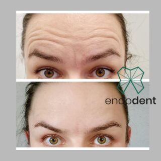 💉 Nie wszystkie terapie przeciwzmarszczkowe są takie same 💉

W ofercie najnowszej generacji toksyna botulinowa - relabotulina, która podnosi poprzeczkę jeszcze wyżej.
Dlaczego pacjenci ją uwielbiają?
✔️ Dłużej utrzymujące się efekty – u 75% pacjentów rezultaty widoczne nawet do 6 miesięcy
✔️ Naturalny, gładki efekt bez „zamrożonej” mimiki
✔️ Szybsze działanie – efekty widoczne wcześniej, nawet juz na drugi dzień

Naszym stałym pacjentom bardzo polecamy wypróbowanie relabotuliny!

Zapraszam,
Endodent Stomatologia Mikroskopowa
☎️+48881666523
📧 gabinet@endodent.pl
endodent.pl