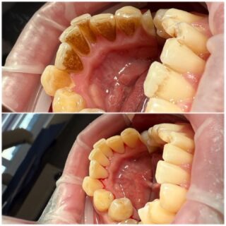 🦷 Higienizacja w gabinecie stomatologicznym — fundament zdrowia

Regularna higienizacja jamy ustnej to nie zabieg kosmetyczny, lecz procedura medyczna, która realnie wpływa na zdrowie całego organizmu.

Dlaczego to takie ważne?
Kamień nazębny jest rezerwuarem bakterii.
Bakterie z jamy ustnej mogą przedostawać się do krwiobiegu i krążyć po organizmie.
Nieleczony kamień prowadzi do zapalenia dziąseł i chorób przyzębia, a w konsekwencji do rozchwiania i utraty zębów.

Na czym polega higienizacja? 
✔️ skaling – usunięcie kamienia naddziąsłowego i poddziąsłowego
✔️ piaskowanie – usunięcie osadów i przebarwień
✔️ polerowanie – wygładzenie powierzchni zębów
✔️ (opcjonalnie) fluoryzacja

Czym jest piaskowanie zębów?
To zabieg polegający na oczyszczaniu zębów strumieniem wody, powietrza i drobnego proszku. Skutecznie usuwa osady po kawie, herbacie czy papierosach, docierając tam, gdzie nie sięga szczoteczka.

Zdrowie + estetyka
Po higienizacji zęby stają się gładsze i optycznie jaśniejsze, a oddech wyraźnie świeższy. 

Jak często?
➡️ minimum raz w roku
➡️ u wielu pacjentów — co 6 miesięcy, a czasem częściej (indywidualna ocena) 

Podczas wizyty higienistka
przeprowadza instruktaż higieny jamy ustnej,
dobiera indywidualne preparaty do codziennej pielęgnacji w domu (szczoteczki, pasty, nici, irygatory).
📌 Profilaktyka to najprostsza i najtańsza droga do zdrowych zębów i dziąseł.
Nie odkładaj higienizacji — to inwestycja w zdrowie, nie tylko w uśmiech.

Zapraszamy
🌍 endodent.pl
☎️ 881666523
📧 gabinet@endodent.pl